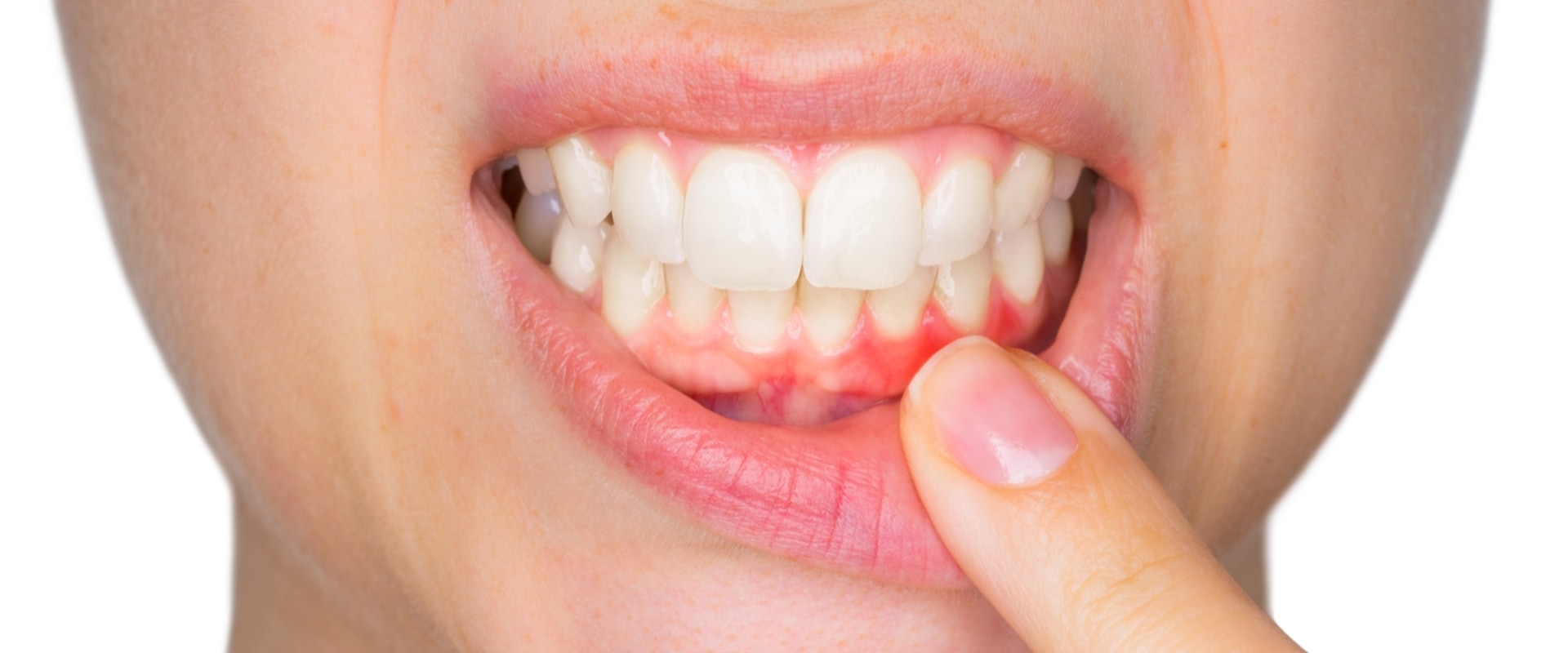 The Impact of Stress on Gum Disease and How to Reverse It: An Expert's Perspective