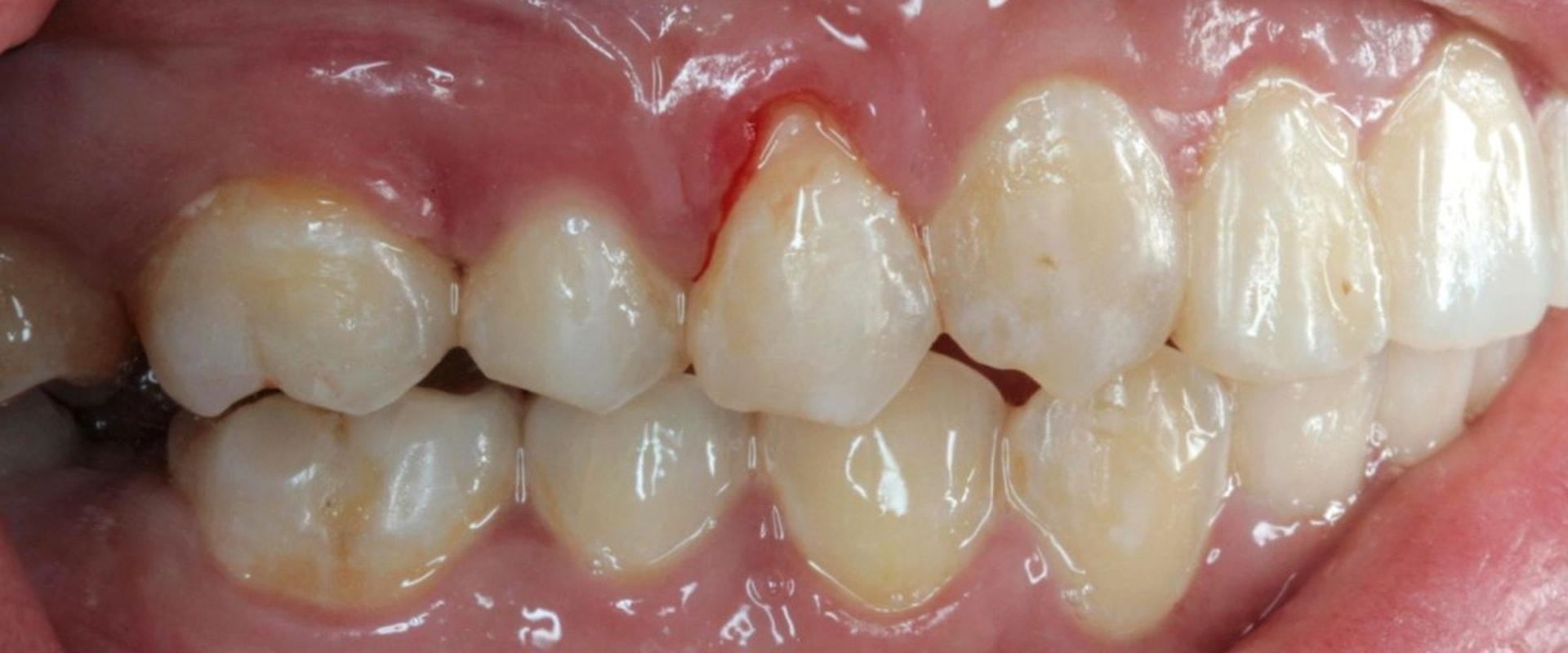 Reversing Gum Disease: A Comprehensive Guide to Understanding Symptoms and Treatment Options