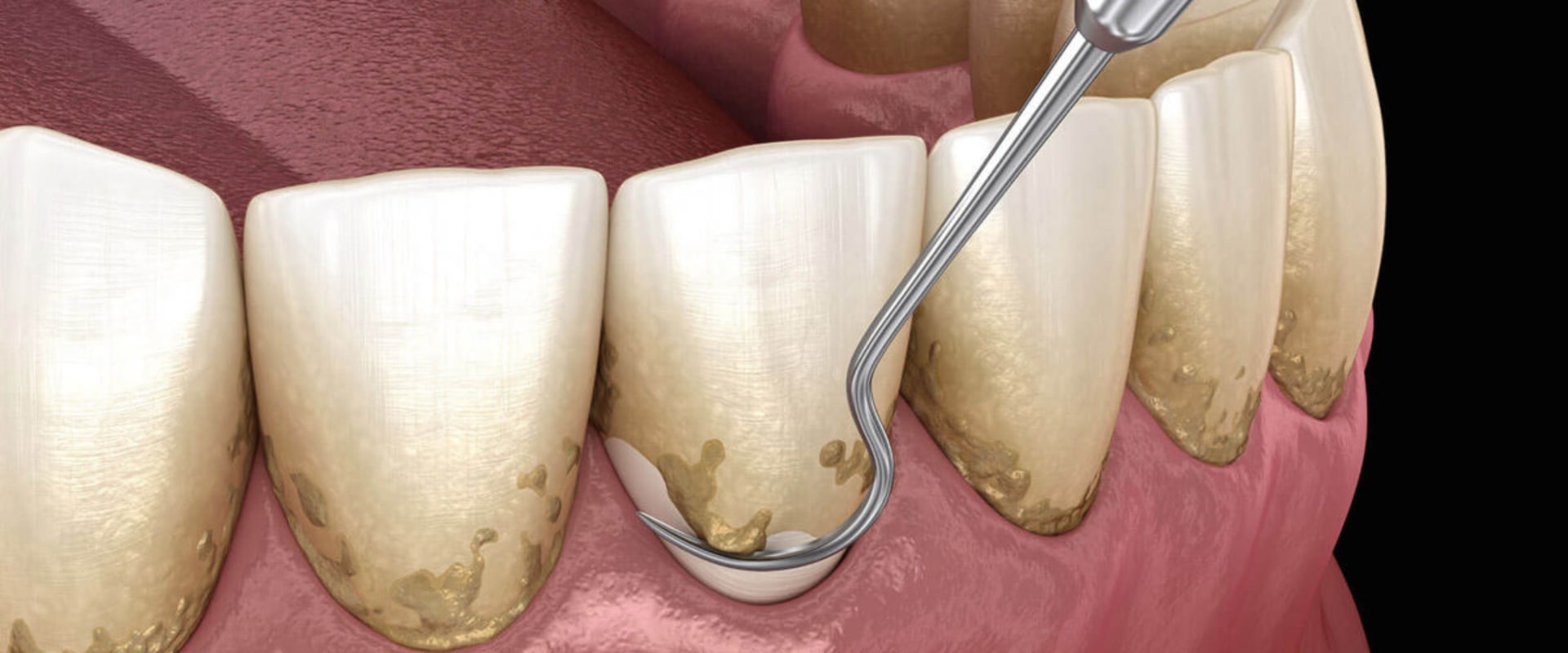 Reversing Gum Disease: The Power of Scaling and Root Planing