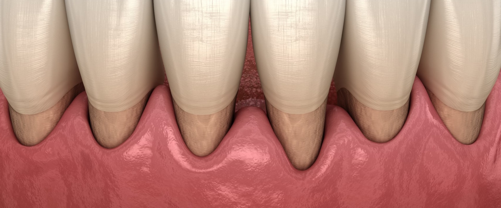 Reversing Gum Disease: My Expert Tips and Strategies
