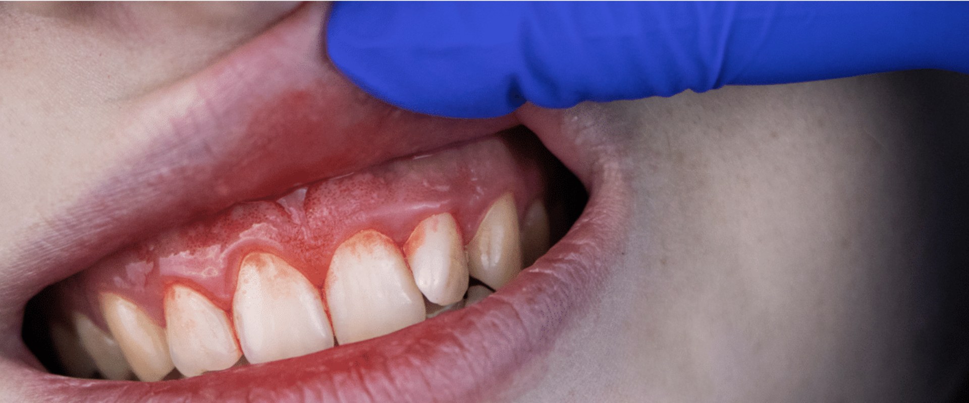 The Impact of Stress on Gum Disease and How to Reverse It