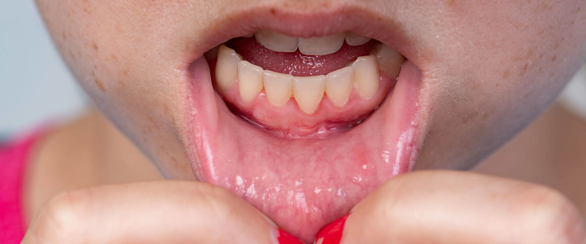 How to Know if Your Gum Disease is Improving
