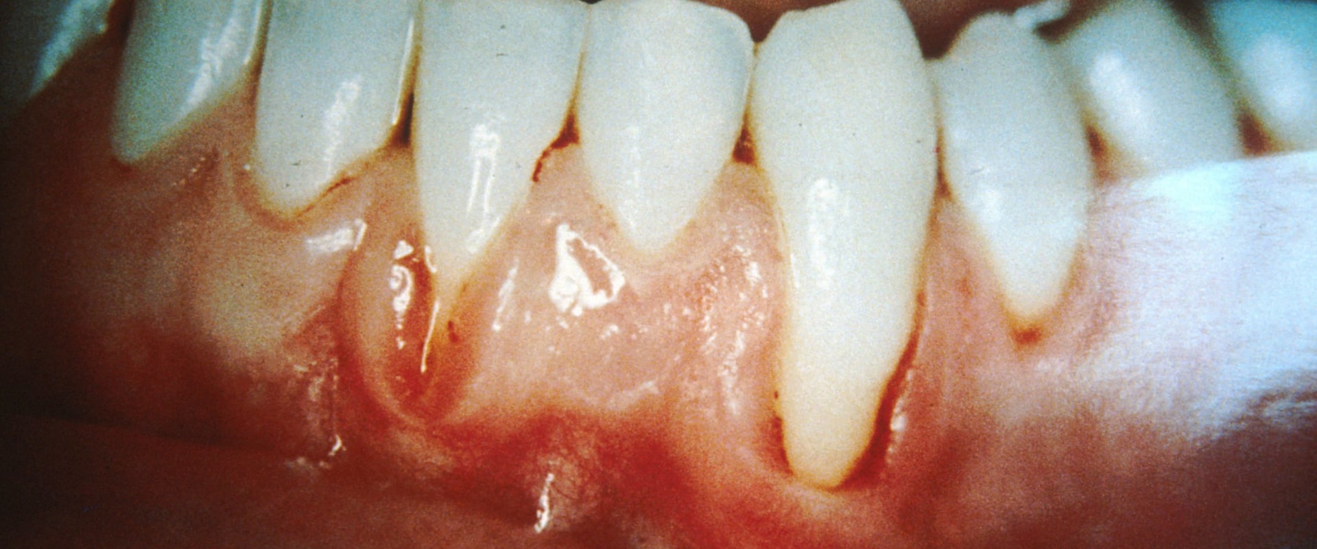 The Truth About Oil Pulling and Gum Disease