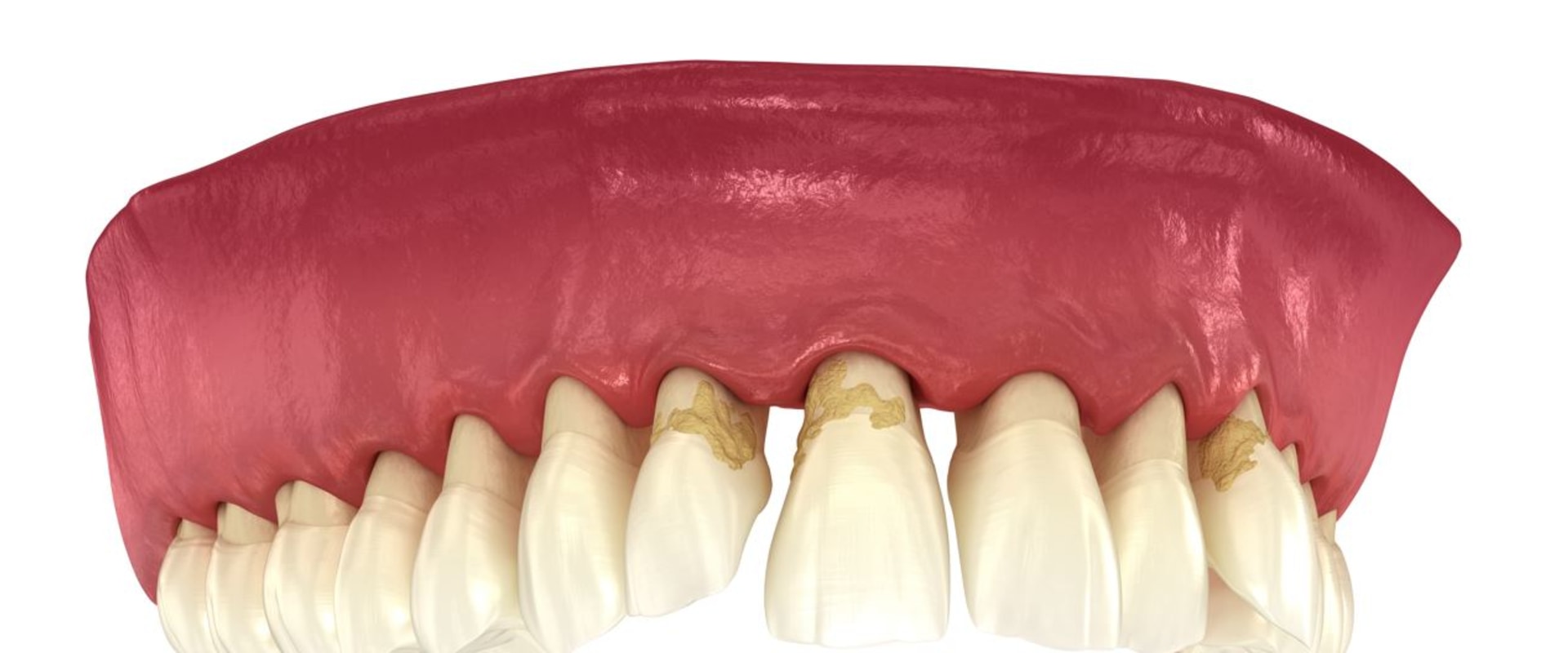 The Importance of Reversing Gum Disease for Preventing Tooth Loss