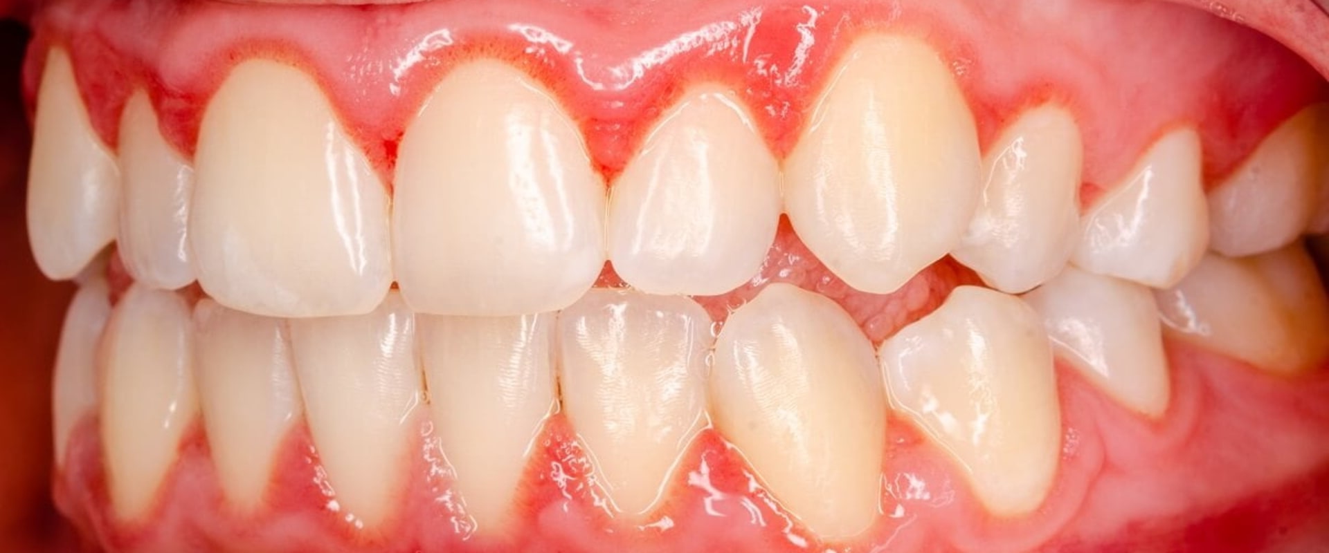 The Power of Good Oral Hygiene: How to Reverse Gum Disease