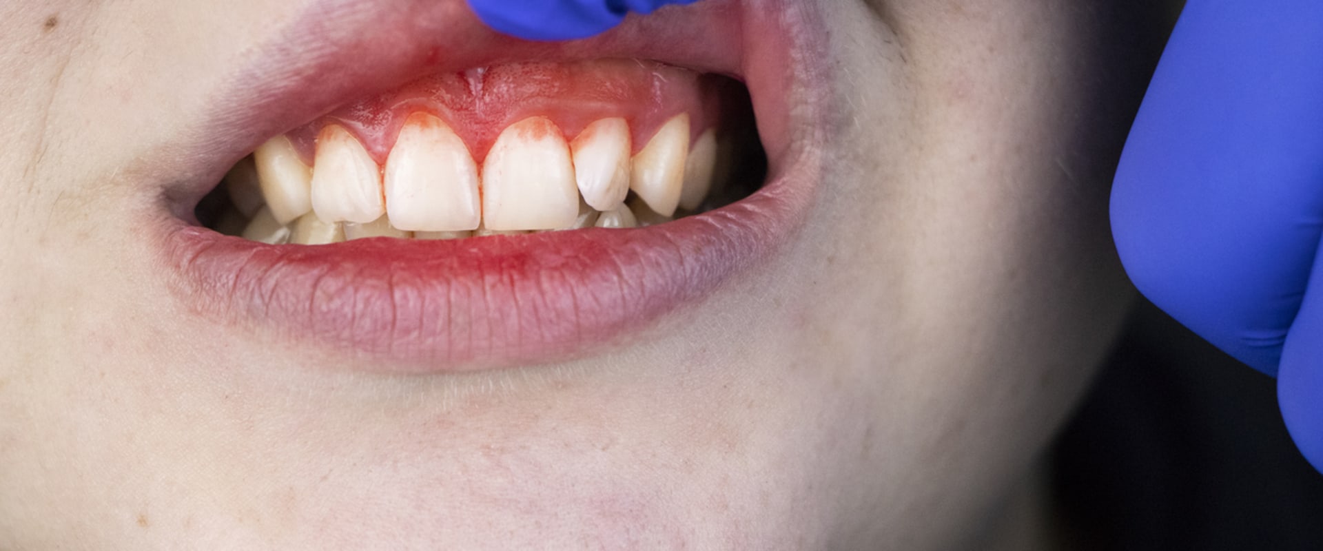 The Importance of Good Oral Hygiene in Reversing Gum Disease