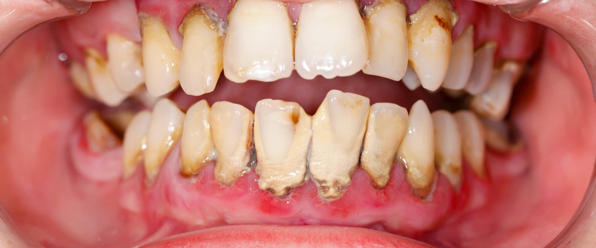 The Truth About Reversing Gum Disease