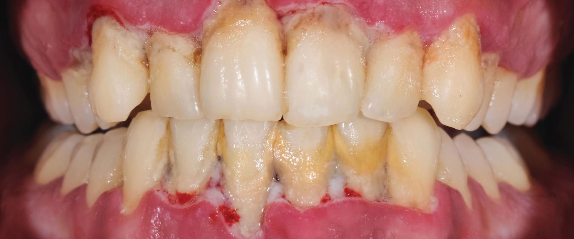 The Surprising Connection Between Diabetes and Gum Disease Reversal