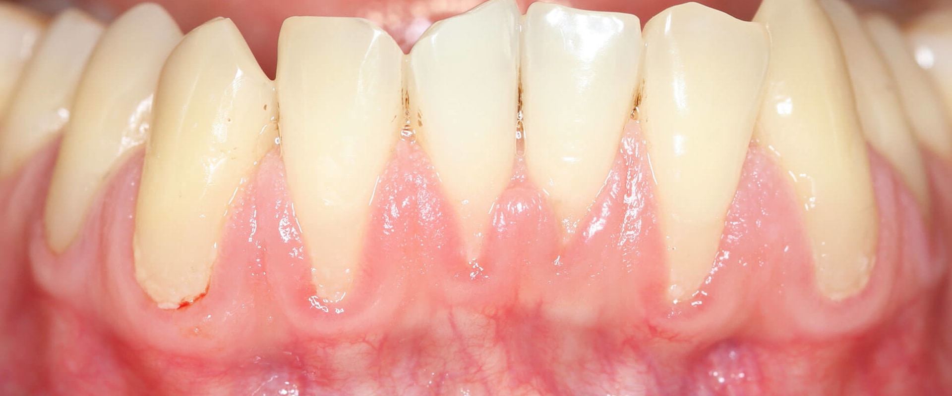 The Power of Diet in Reversing Gum Disease