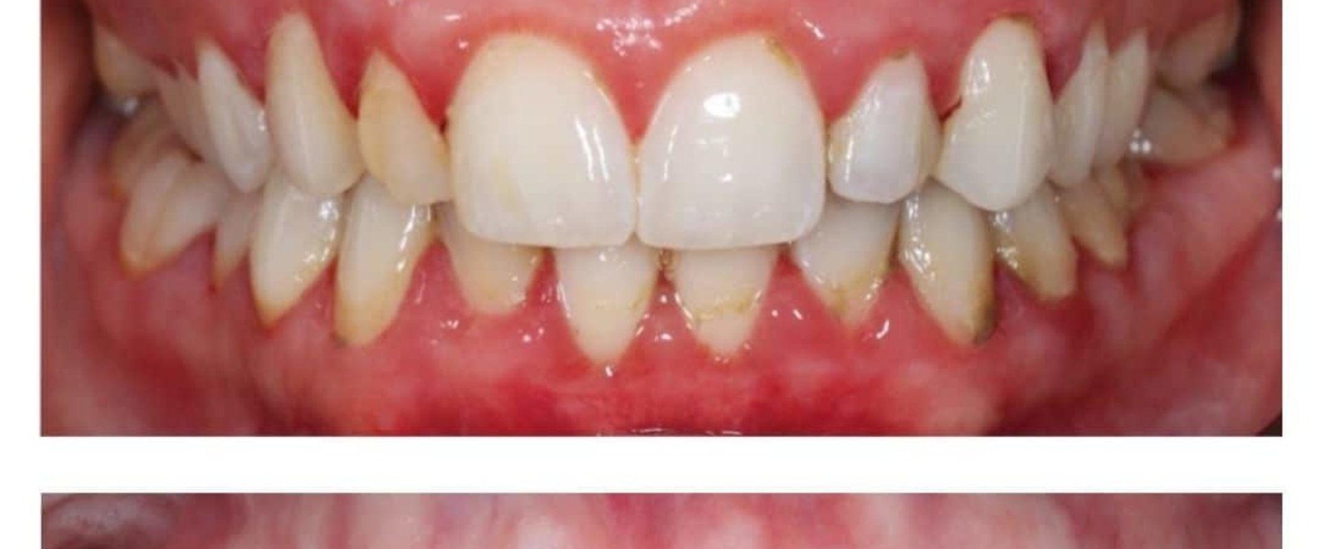 Expert Insights on Reversing Gum Disease and Restoring Your Oral Health