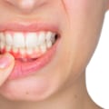 The Hidden Dangers of Untreated Gum Disease: How to Protect Your Oral Health