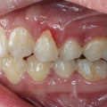Reversing Gum Disease: A Comprehensive Guide to Understanding Symptoms and Treatment Options