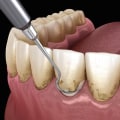 Reversing Gum Disease: The Power of Scaling and Root Planing