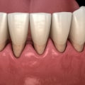 Reversing Gum Disease: My Expert Tips and Strategies