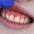 The Impact of Stress on Gum Disease and How to Reverse It