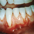 The Truth About Oil Pulling and Gum Disease