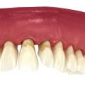 The Importance of Reversing Gum Disease for Preventing Tooth Loss