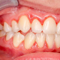 The Power of Good Oral Hygiene: How to Reverse Gum Disease