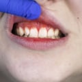The Importance of Good Oral Hygiene in Reversing Gum Disease
