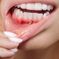 The Truth About Smoking and Gum Disease: How to Reverse the Damage