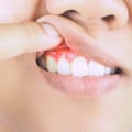 The Importance of Flossing for Reversing Gum Disease: An Expert's Perspective