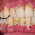 The Surprising Connection Between Diabetes and Gum Disease Reversal