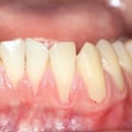 The Power of Diet in Reversing Gum Disease