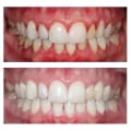 Expert Insights on Reversing Gum Disease and Restoring Your Oral Health