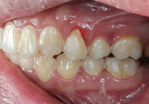Reversing Gum Disease: A Comprehensive Guide to Understanding Symptoms and Treatment Options