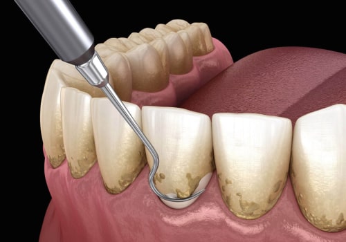 Reversing Gum Disease: The Power of Scaling and Root Planing