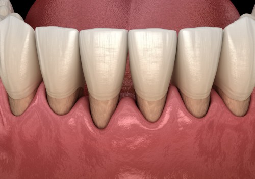 Reversing Gum Disease: My Expert Tips and Strategies