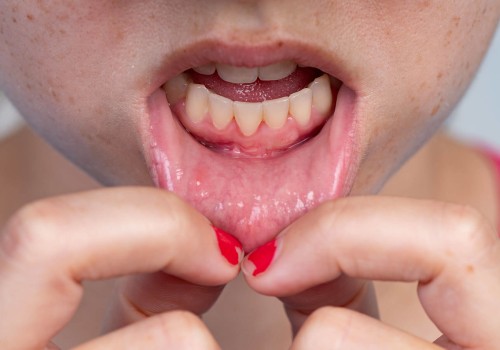 How to Know if Your Gum Disease is Improving