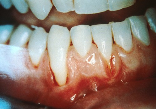 The Truth About Oil Pulling and Gum Disease