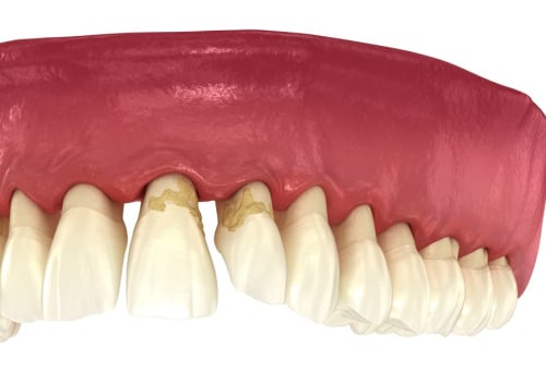 The Importance of Reversing Gum Disease for Preventing Tooth Loss