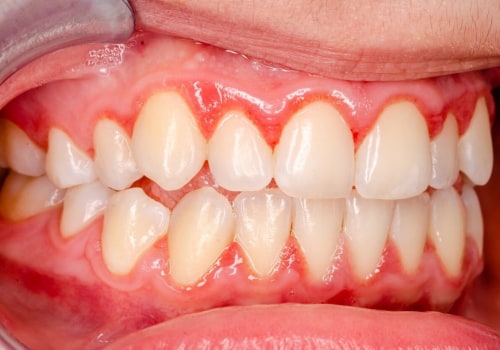 The Power of Good Oral Hygiene: How to Reverse Gum Disease