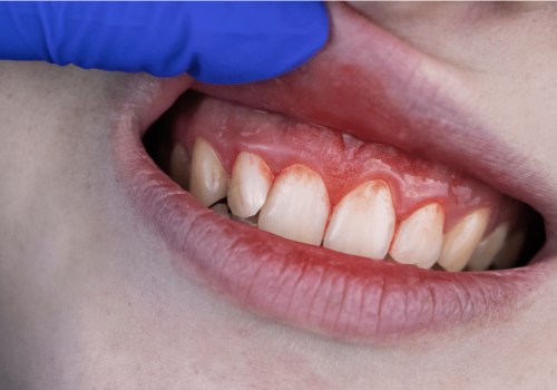 The Power of Natural Remedies for Reversing Gum Disease