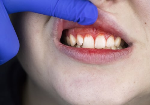 The Importance of Good Oral Hygiene in Reversing Gum Disease