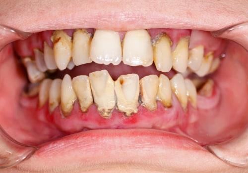 The Truth About Reversing Gum Disease