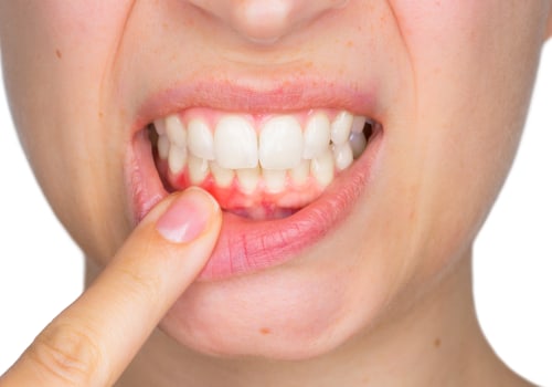 The Silent Killer: Understanding and Preventing Gum Disease