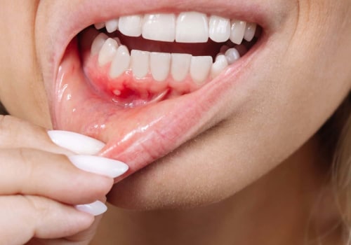 The Truth About Smoking and Gum Disease: How to Reverse the Damage