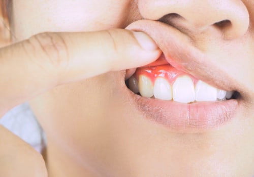 The Importance of Flossing for Reversing Gum Disease: An Expert's Perspective