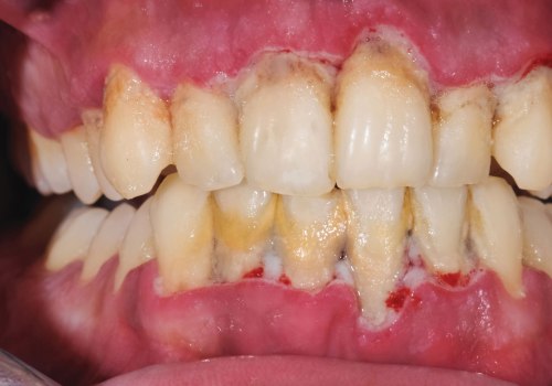 The Surprising Connection Between Diabetes and Gum Disease Reversal