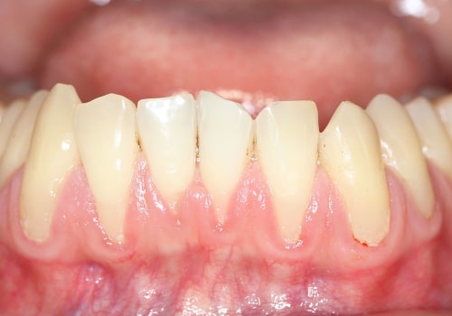The Power of Food in Reversing Gum Disease