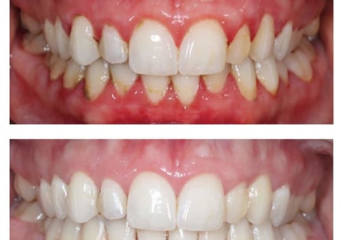 Expert Insights on Reversing Gum Disease and Restoring Your Oral Health